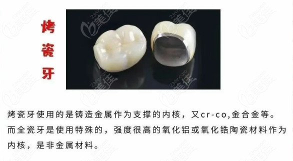 烤瓷牙套