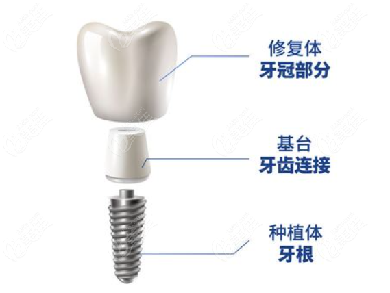 武汉同济口腔医院种植牙价格表