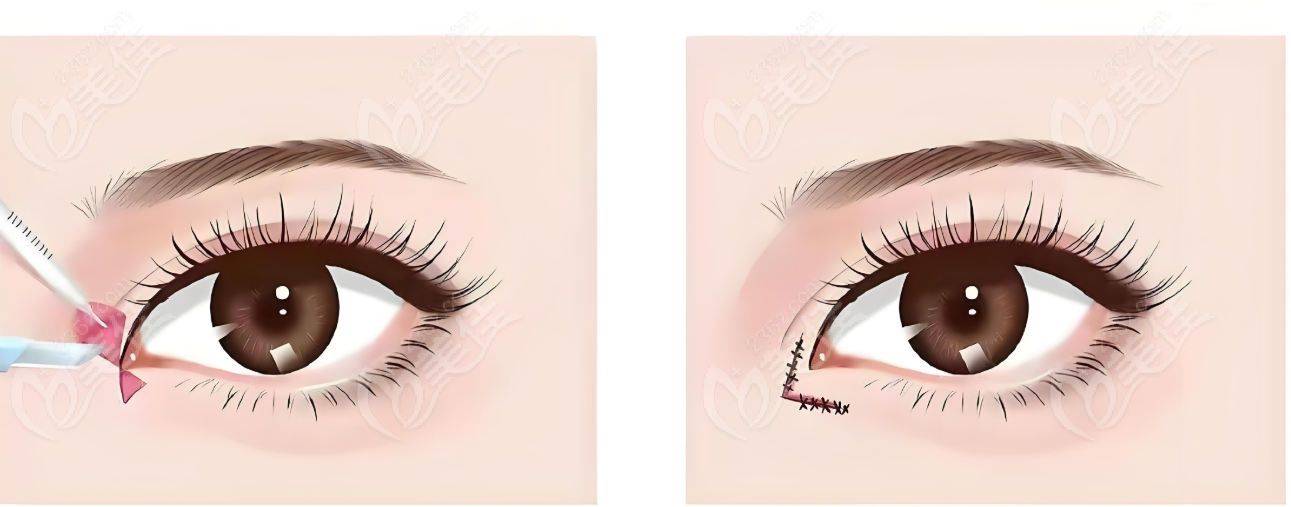 郝立君雙眼皮修復(fù)怎么樣