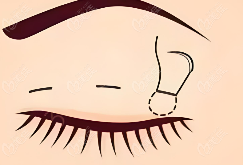 郝立君修復(fù)雙眼皮要多少錢