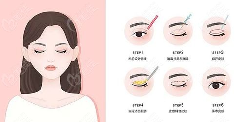 苏州双眼皮修复医院