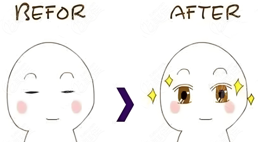 王恒的雙眼皮修復(fù)技術(shù)