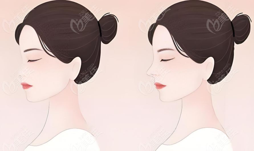 杭州清沐隆鼻对比图