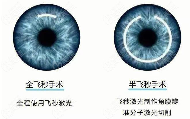 飞秒近视手术www.236z.com