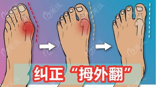 上海虹桥医院治疗拇外翻成效怎么样