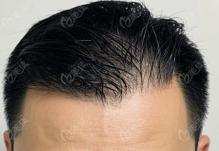 紹興金柯橋植發(fā)醫(yī)院靠譜嗎？精細(xì)植發(fā)技術(shù)解析
