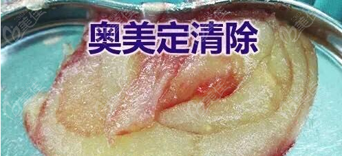奥美啶注射隆胸取出术价格