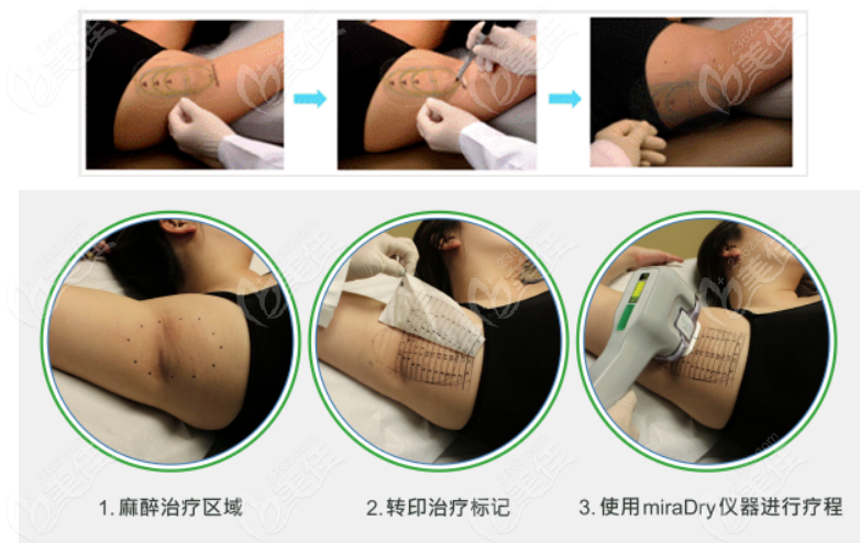 miradry微波治疗腋臭成效好，但这四种人不能做