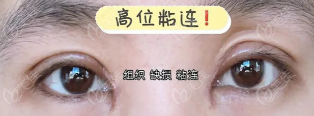 肖阿能双眼皮失败修复实例