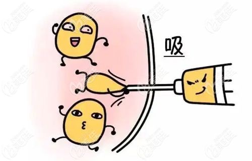 南京吸脂手术避坑