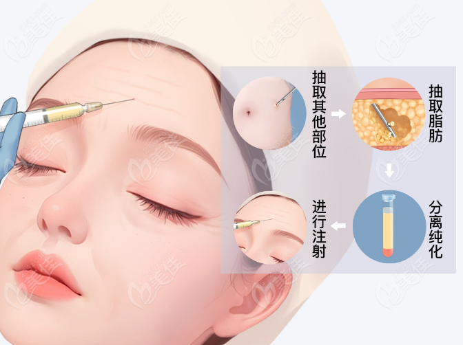 冯斌自体脂肪主要做面部好