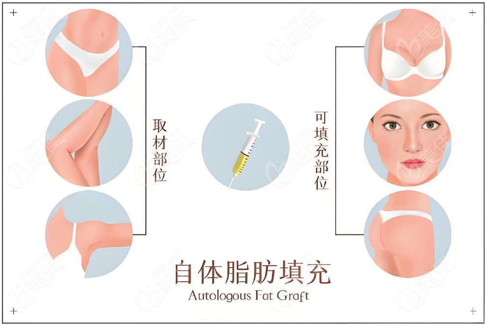 冯斌自体脂肪主要做胸部好