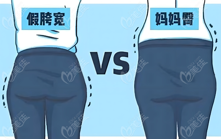 媽媽臀抽脂加臀部凹陷填充前后對比圖