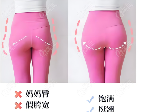 媽媽臀抽脂加臀部凹陷填充前后對比圖