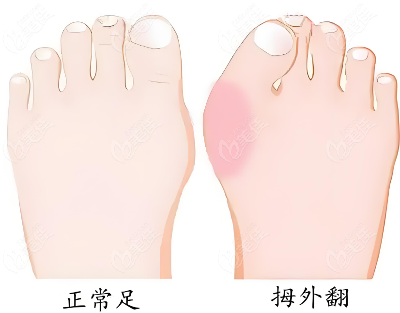 上海拇指外翻微创手术哪家好