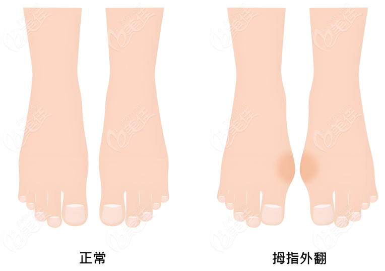 上海拇指外翻微创手术