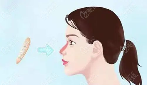 李健5000+鼻综合实例