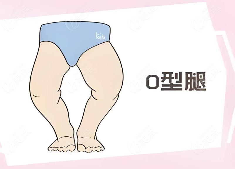 上海直腿术哪家强 上海直腿术哪家强