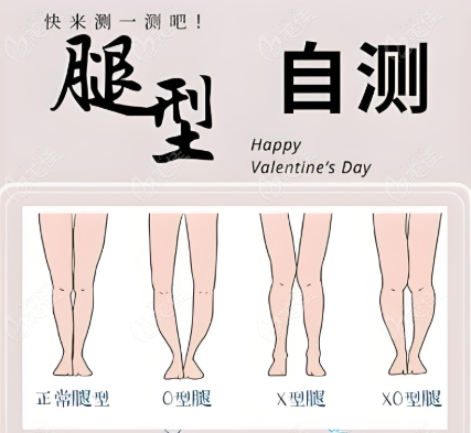 上海直腿术腿型测试 上海直腿术腿型测试