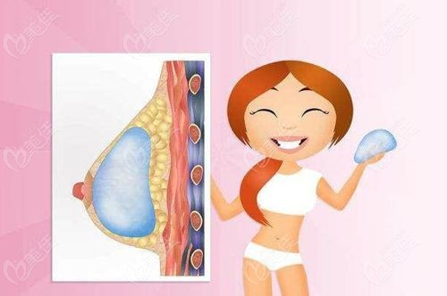 广州朱云隆胸医生口碑基石