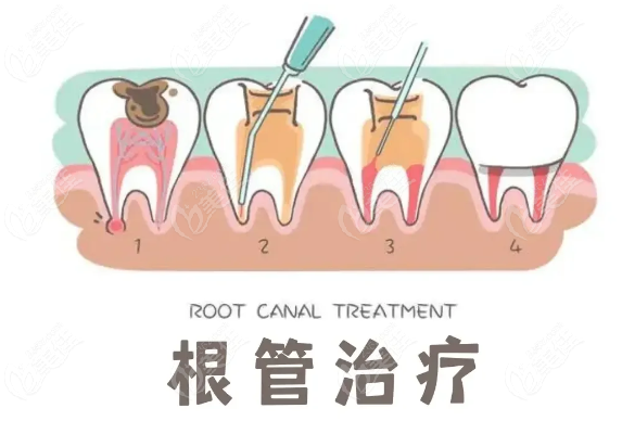 荊門咿呀口腔根管治療價格