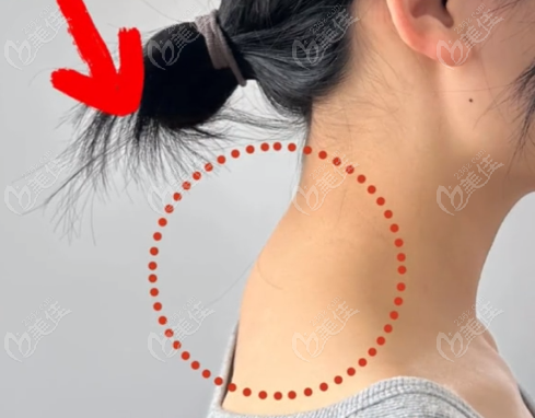 微創(chuàng)乳化富貴包價(jià)格水多深