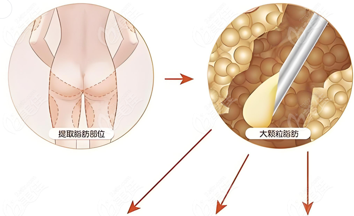 曹孟君的土麦森吸脂技术