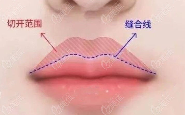 上海张贺医生做人中缩短口碑好
