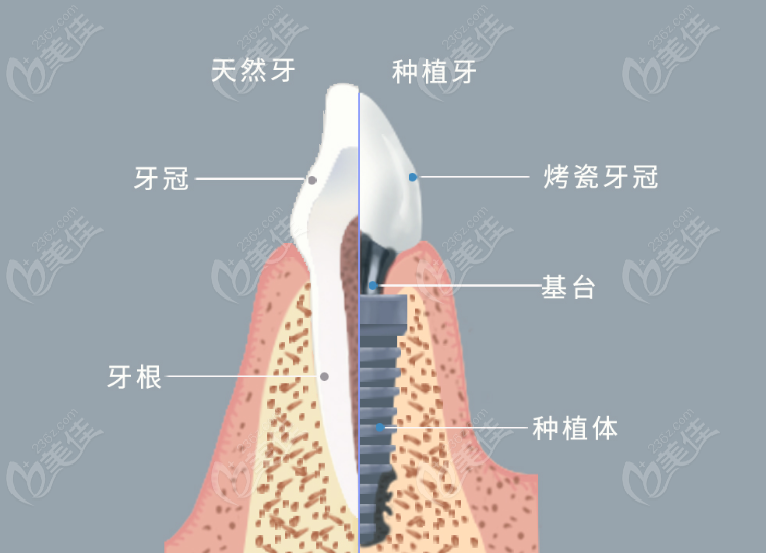 正规医院种植牙价格表
