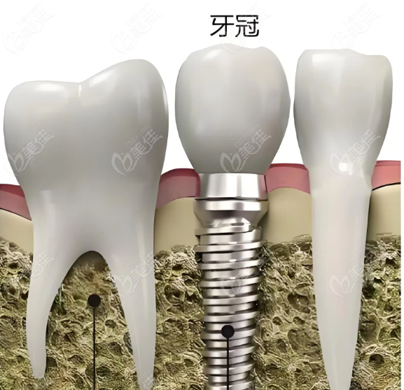 正规医院种植牙价格表