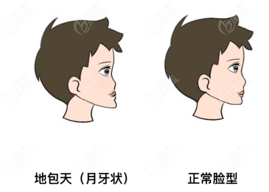 地包天和正常脸型对比