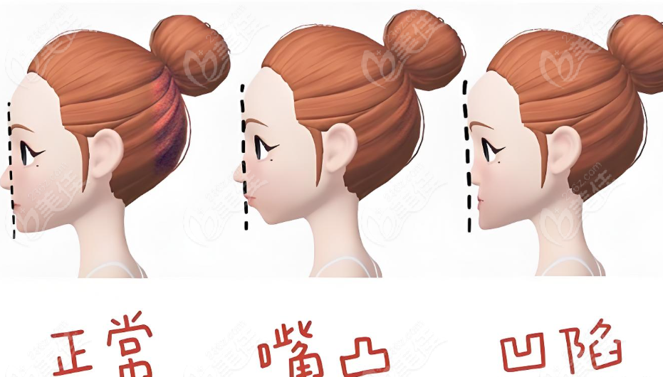 周会喜正颌术后对比图实例 周会喜正颌术后对比图实例
