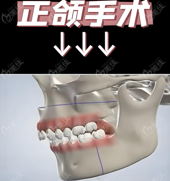 周会喜做正颌手术 周会喜做正颌手术