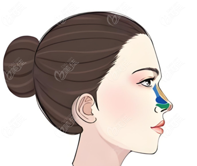 李信鋒鼻修復(fù) 李信鋒鼻修復(fù)