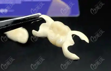 HPP粘接桥牙齿多少钱一颗