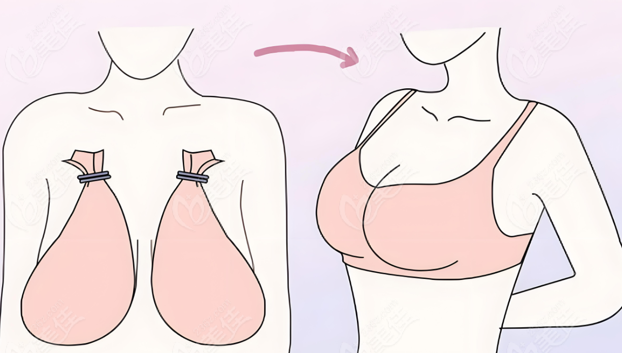 上海海華醫(yī)院巨乳縮小