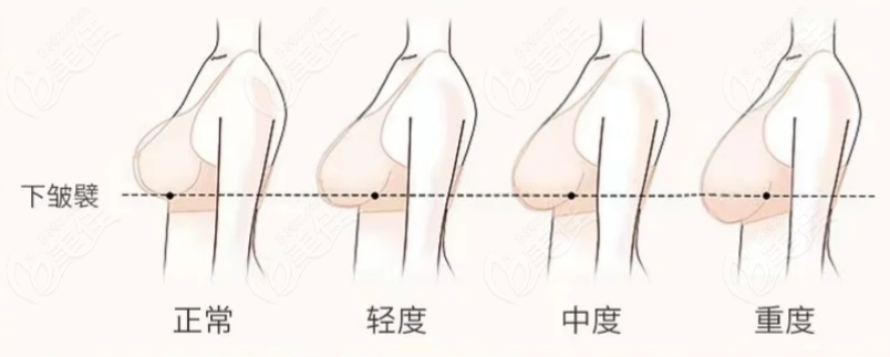 玉寶光乳房懸吊術(shù)技術(shù)測(cè)評(píng)