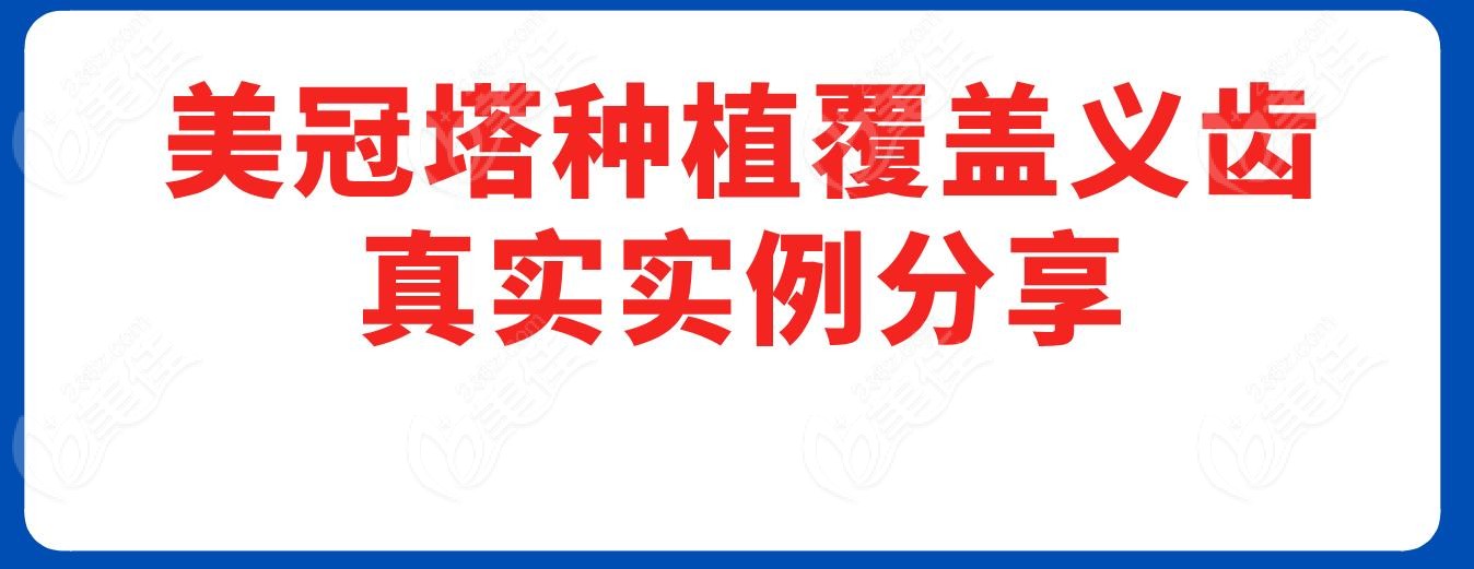 美冠塔种植覆盖义齿真实实例分享