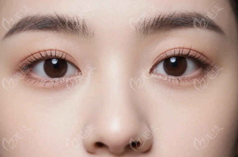 郑州王剑双眼皮吗