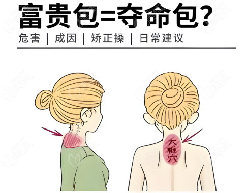 黃學(xué)峰一針去富貴包技術(shù)