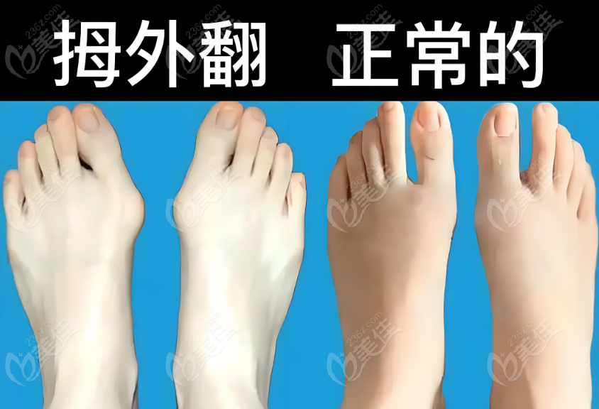 北京做拇外翻微创手术哪个大夫好