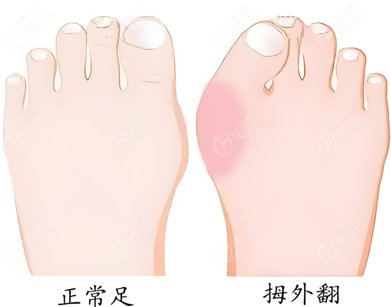 北京做拇外翻微创手术