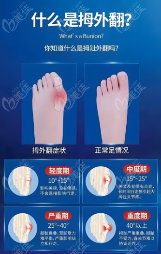 拇外翻手术