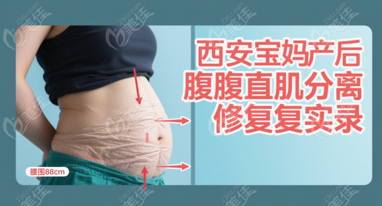 西安寶媽腹壁成形手術(shù)