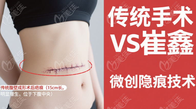 崔鑫醫(yī)生腹壁成形手術(shù)對比