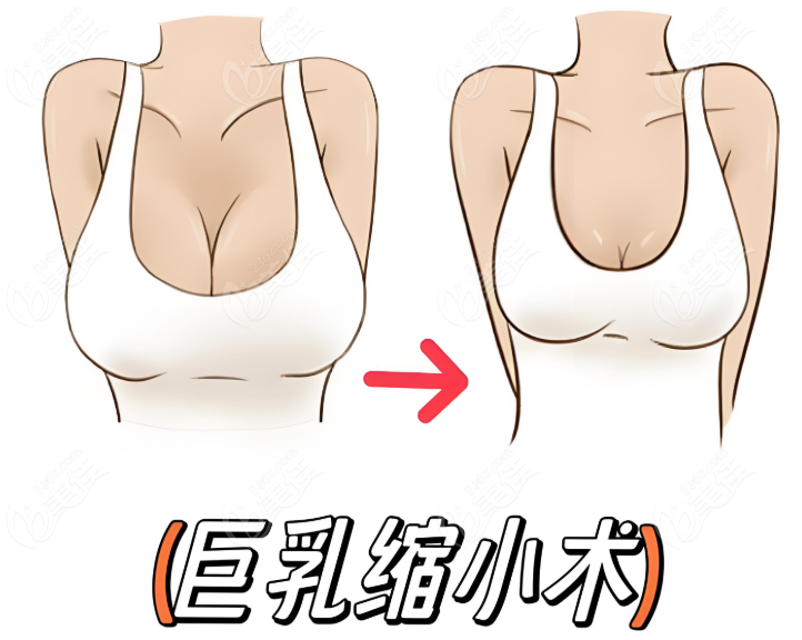 上海巨乳缩小手术对比