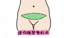 刘宾做腹壁整形手术经验多（尤其擅长处理重度腹直肌分离）