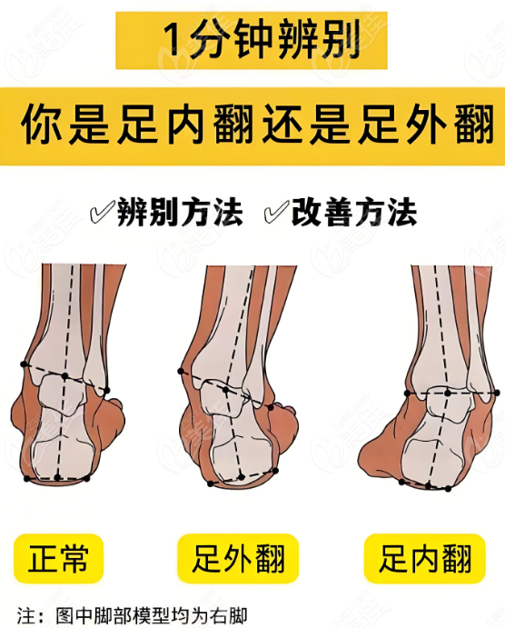 正常脚和足畸形对比