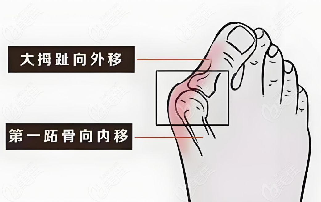马桂文大脚骨真的有那么神奇吗