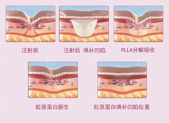 塑妍萃童颜针适合哪些部位